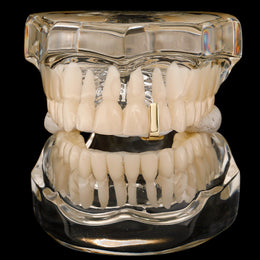 Gold smooth bar tooth cap shown on the front of a clear dental display